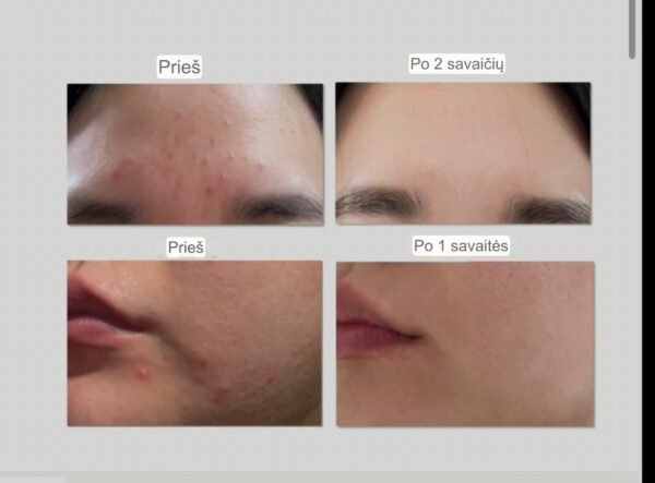 EHAD aczero serum (50g)